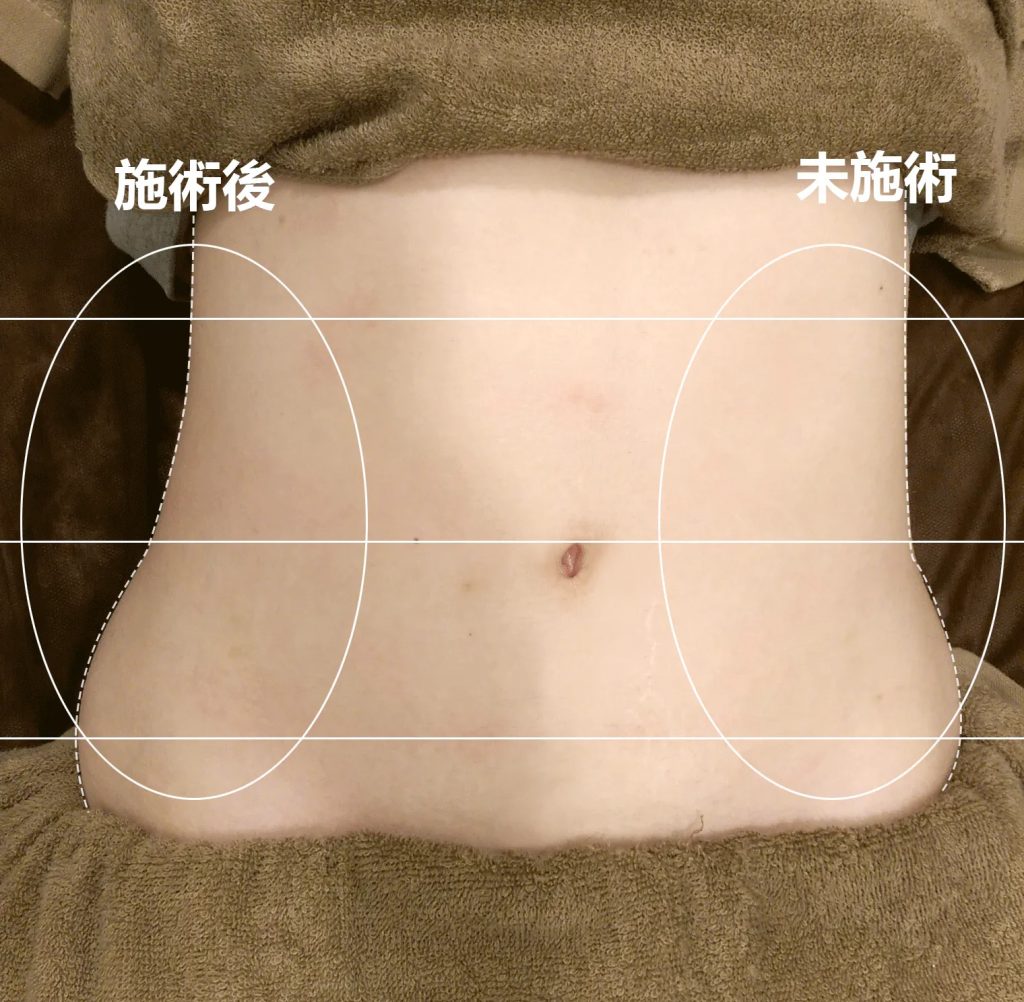 腹部雕塑按摩 13 腹部雕塑按摩流程-11