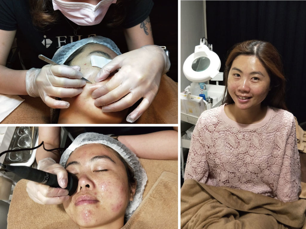 【清除粉刺林，亮白美膚】顧客見證分享