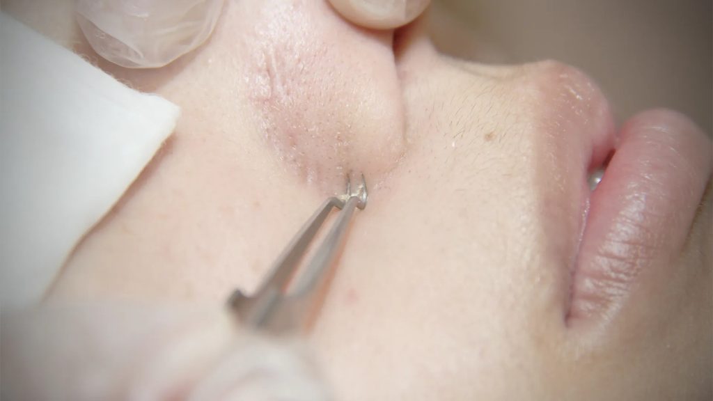 粉刺護理流程-6