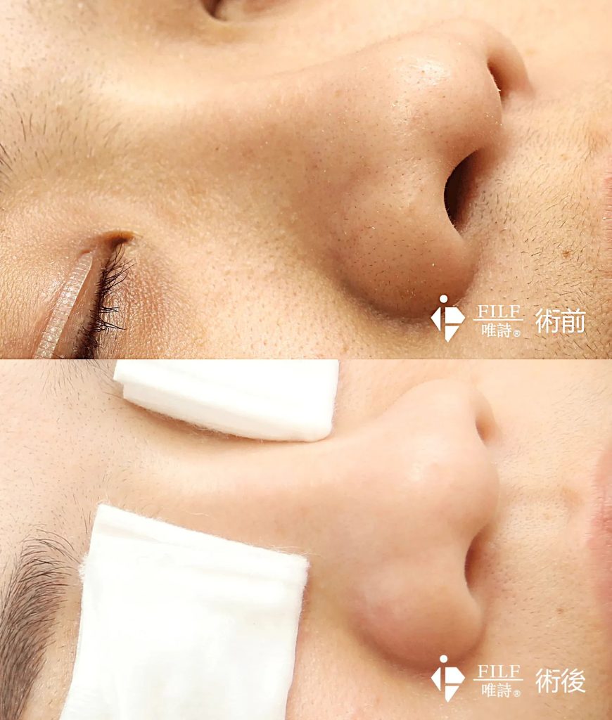 粉刺護理流程-10