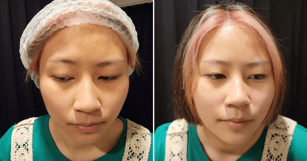 【水亮無痛清粉刺】顧客見證分享