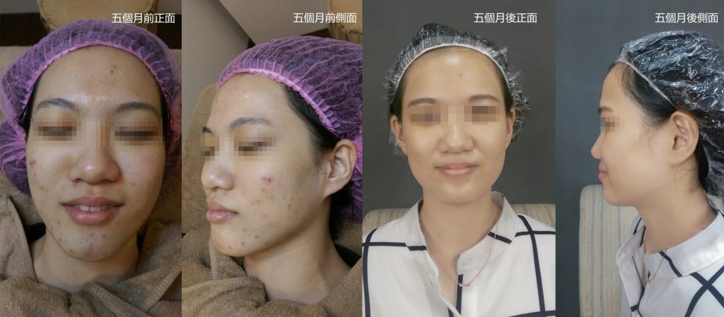 杏仁酸喚膚流程-5