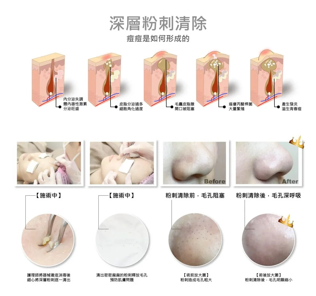 清粉刺圖解