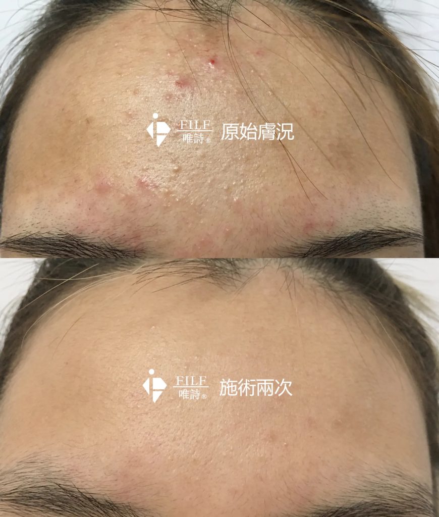 海藻微晶喚膚 11 海藻微晶喚膚流程-9