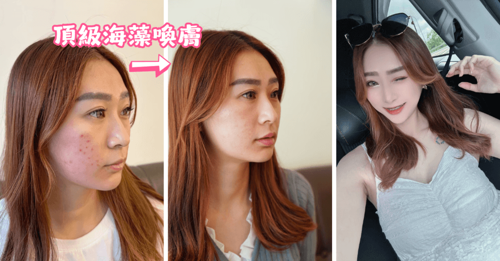 【海藻喚膚-痘痘肌的救星】顧客見證分享