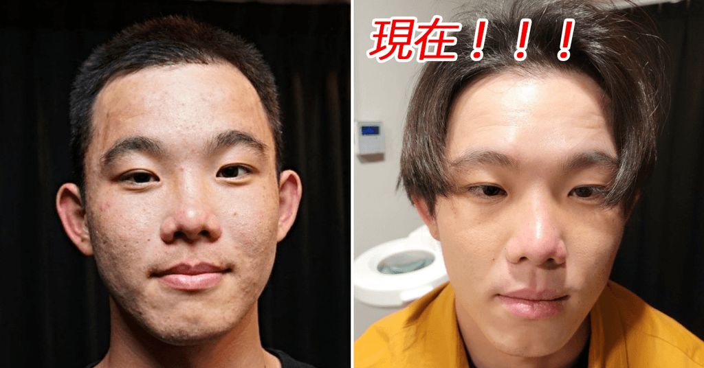 【嚴重膚況保養成果分享】顧客見證分享
