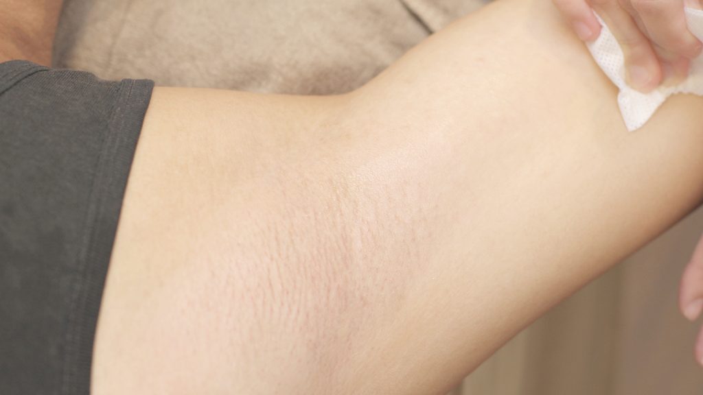 服務項目 17 腋下除毛